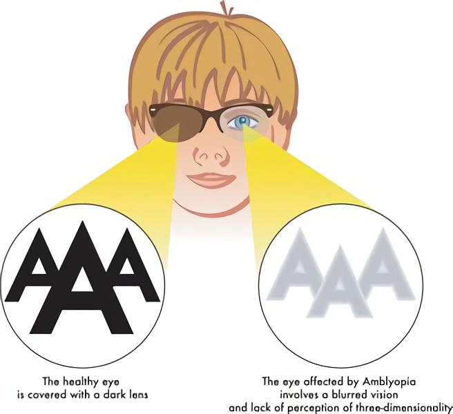 Symptoms of Amblyopia